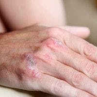 Methotrexate More Effective In Psoriasis Patients Without Psoriatic Arthritis