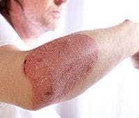 Guselkumab Effective for Treatment of Moderate-to-Severe Plaque Psoriasis