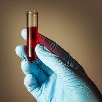New Blood Test Reveals Risk of Atrial Fibrillation and Stroke 