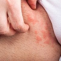 Rheumatoid Arthritis Drug Tofacitinib Can Successfully Treat Eczema