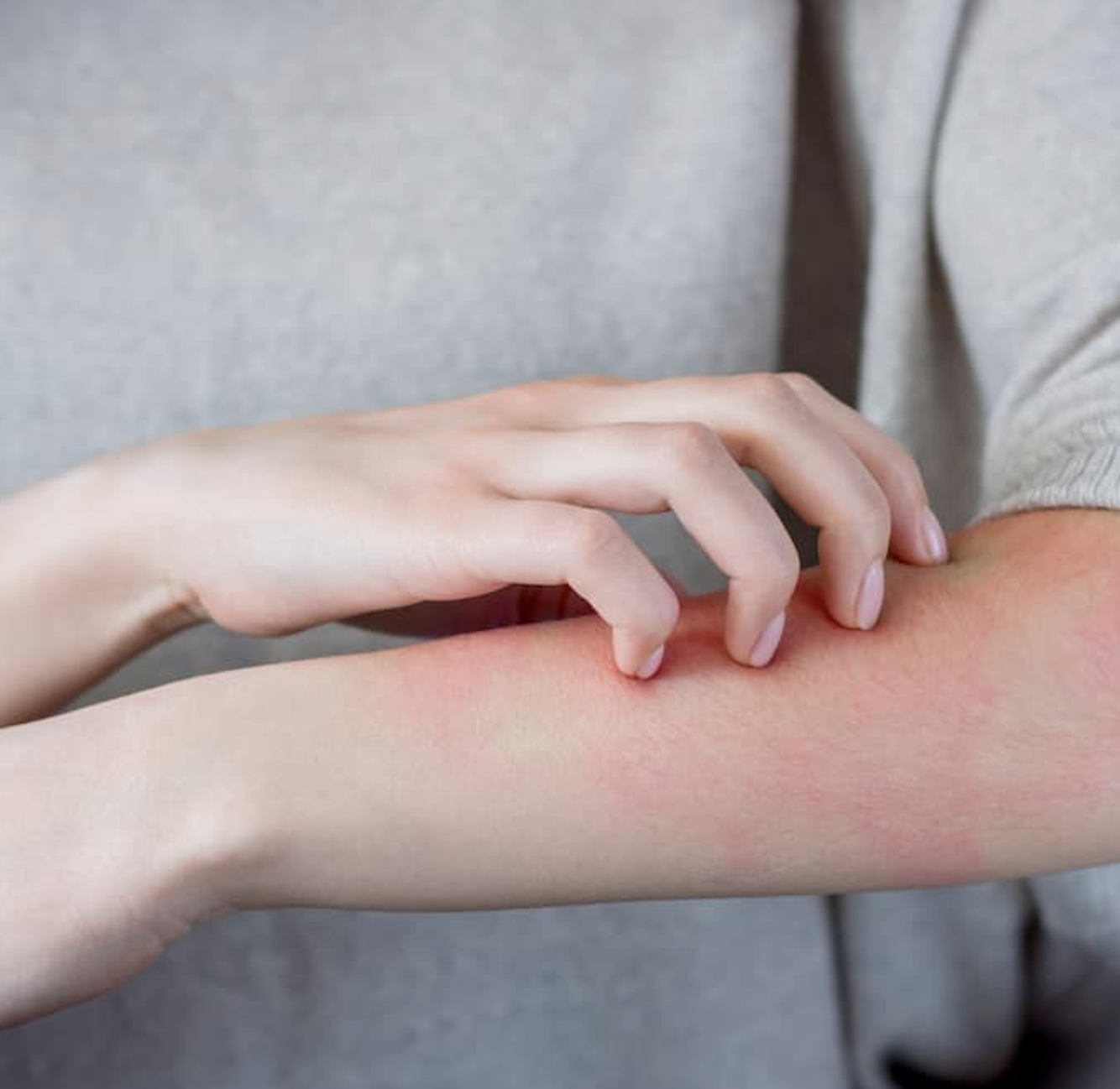Concomitant Atopic Dermatitis in Patients with PsA Could Help Predict Treatment Response 