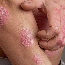 Biologics Efficacy, Safety Not Significantly Impacted by Comorbidities in Older Adults with Psoriasis