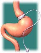 Bariatric Surgery Reduces Risk of Subsequent Atrial Fibrillation