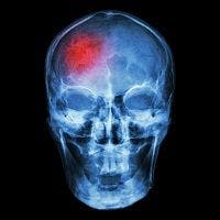 Migraine Medications Underprescribed for Unsupported Risks