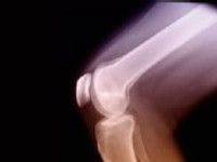 3D Printer Creates Replacement Cartilage for Osteoarthritis 