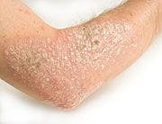 Study Endorses Early TNF Use in Patients with Psoriasis
