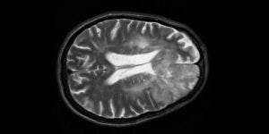 Cortical Lesions Reveal New MS Pathway