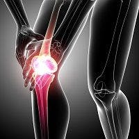 Men Show Better Function After Total Knee Replacement Than Women