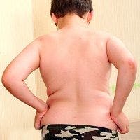 Back Pain Increasingly Common in Adolescents
