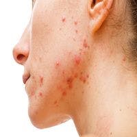 Favorable Results from Dermira's DRM01 Acne Program