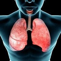 CD4 Cell Count May Indicate COPD Risk in HIV-Positive Patients