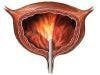 Cystoscopy Alone Most Cost-Effective for Monitoring Bladder Cancer Recurrence