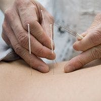 Acupuncture for Kids? Study Says Yes