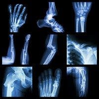 Breaking a Bone Could Mean Chronic Widespread Body Pain Down the Line