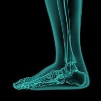 Heel Spurs: A New Approach to Treatment