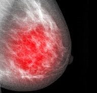 Alexithymia Associated with Post-Op Pain Risk in Breast Cancer