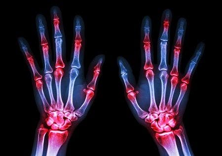 Tapering of Biologics for Rheumatoid Arthritis Successful, Cost-Effective in Patients with Low Disease Activity