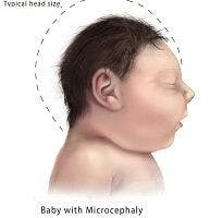 Zika: Babies' Heads Looked Normal, then Stopped Growing