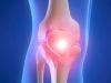 Omega-3 Fatty Acids Shown to Slow Progression of Knee Osteoarthritis