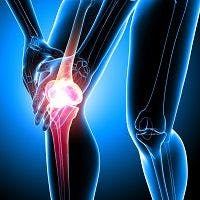 Knee Osteoarthritis Linked to Neuropathy 