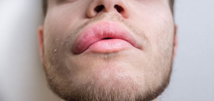 Oral Plasma Kallikrein Inhibitor Significantly Reduces Attacks of Hereditary Angioedema
