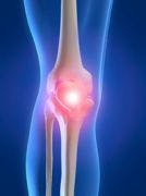 Patient-Reported Knee Pain Often Indicates Osteoarthritis 