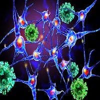 Iron Accumulation in Brain a Mysterious Sign in Multiple Sclerosis