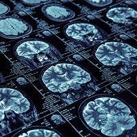 Lipoic Acid May Limit Brain Atrophy in SPMS Patients
