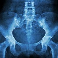 Merck Pulls the Plug on Osteoporosis Drug Despite Reduced Osteoporotic Fractures