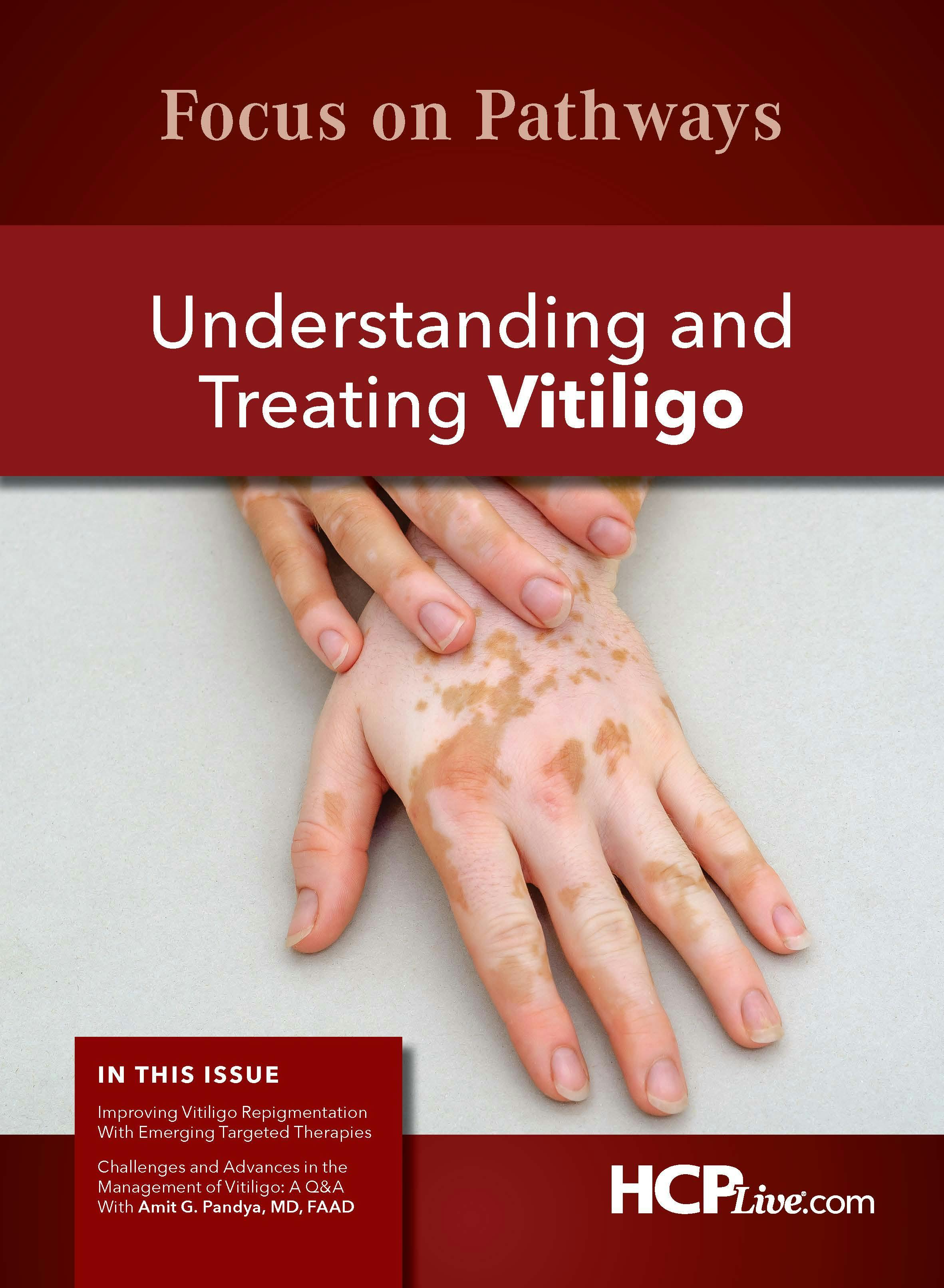 Understanding and Treating Vitiligo