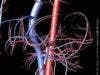 Intensive Medical Therapy Is Reducing the Indications for Carotid Revascularization in Asymptomatic Patients