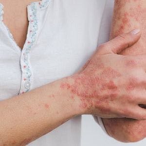 Study Reveals Key Insights on 5-Year Retention Rate, Efficacy of Secukinumab for Psoriasis Patients 