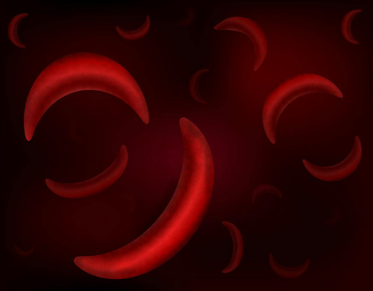 Patients with Sickle Cell Disease Benefit Most from Interventions That Reduce Hemolytic Anemia