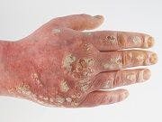 First Fully Human IL-17A Inhibitor Shows Sustained Efficacy, Safety Profile for Psoriasis Treatment