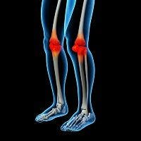 Painful Knee Osteoarthritis Suggests Early Mortality in Women