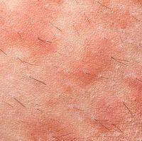Upadacitinib Demonstrates Safety and Efficacy for Atopic Dermatitis