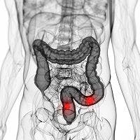 Diverticulosis and Diverticulitis: When is Surgery Prudent?