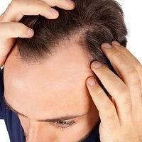 Economic Burden of Alopecia Areata Shown to be Significant Due to Work Impairment