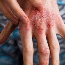 Dupilumab Effective With or Without Topical Corticosteroids for Atopic Dermatitis
