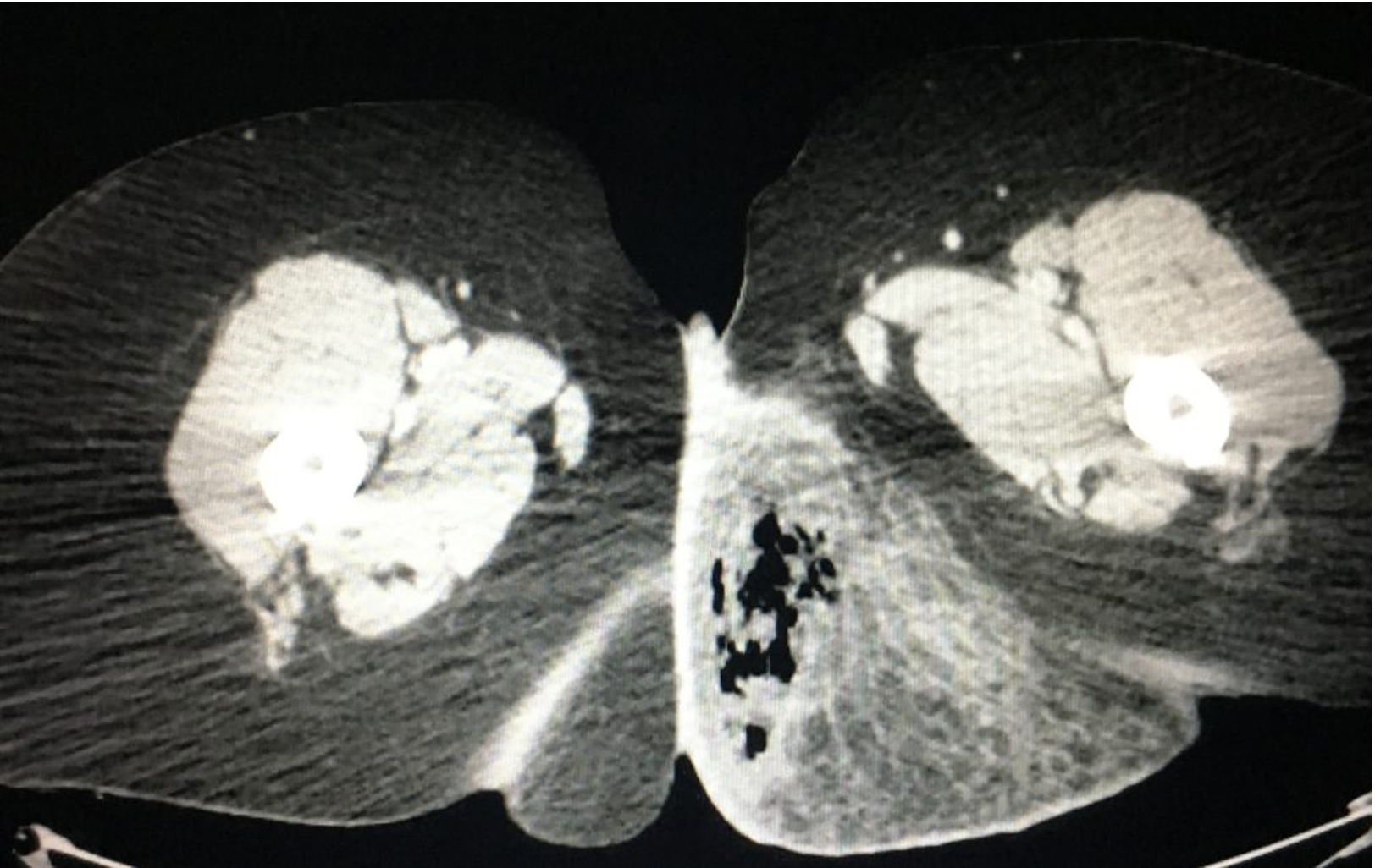 CT scan of a patient's buttock.
