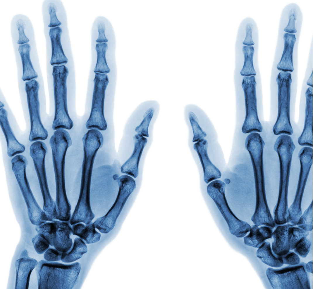 Long-Term Cumulative Joint Inflammation Linked to Joint Damage Progression in Rheumatoid Arthritis