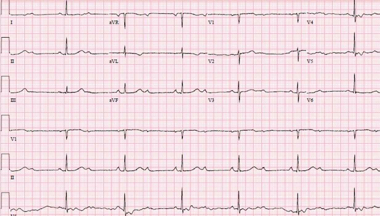chest pains EKG
