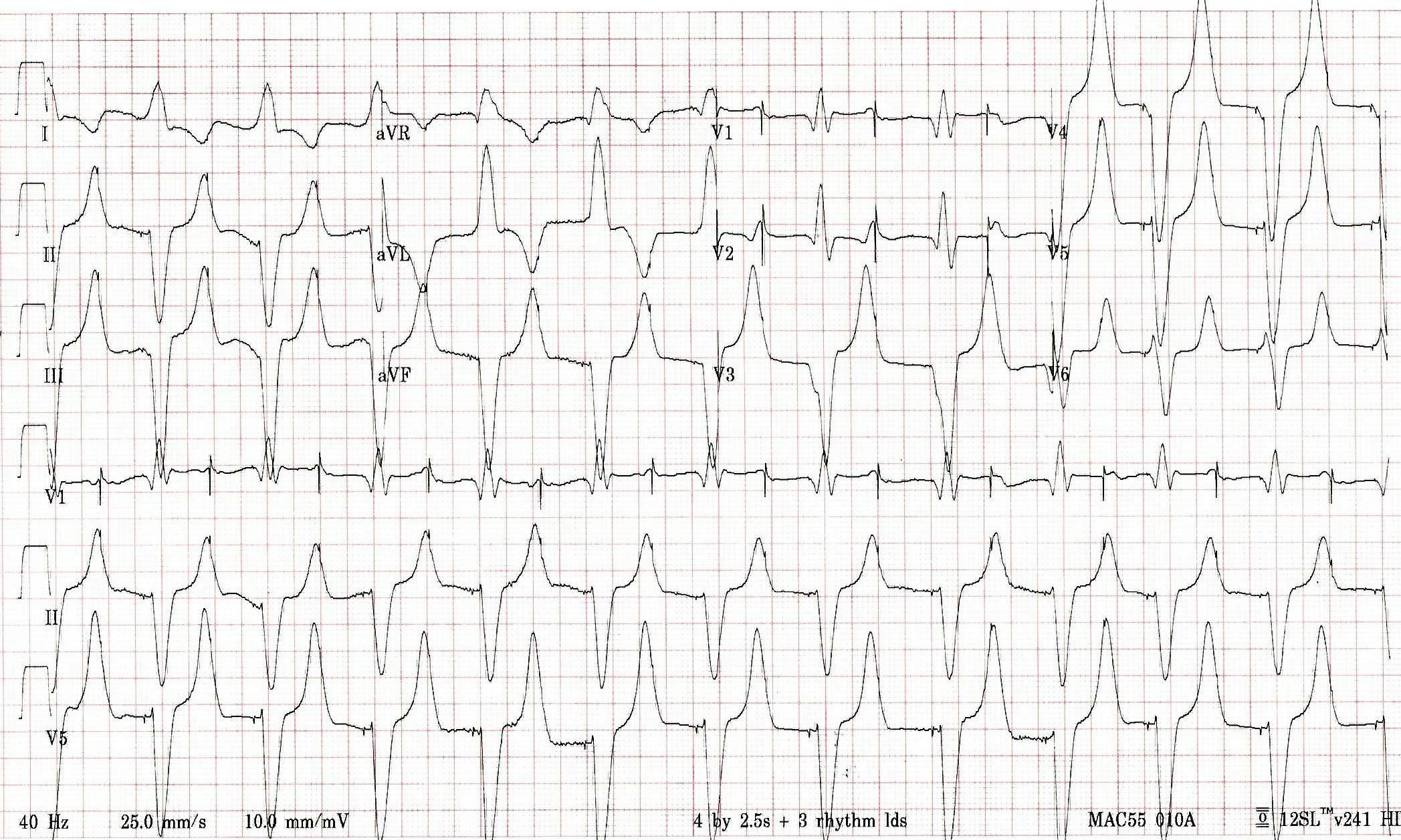 ECG printout from a patient in the hospital featured in this case report