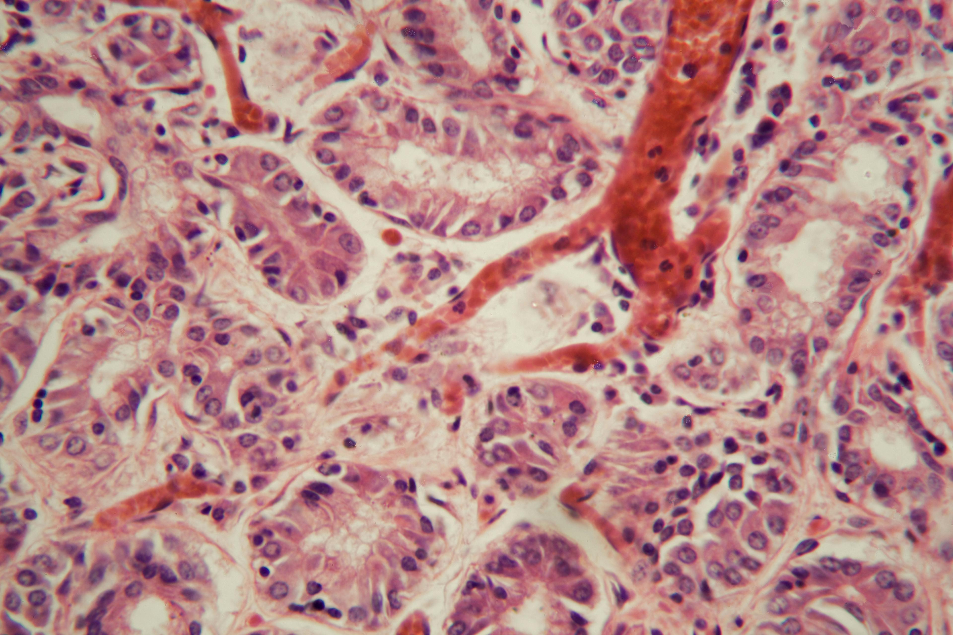 Human lung tissue with Pulmonary embolism under a microscope. 