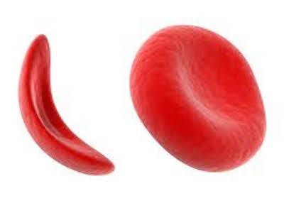 Sickle Cell Treatment Endari Now Available in the United States 