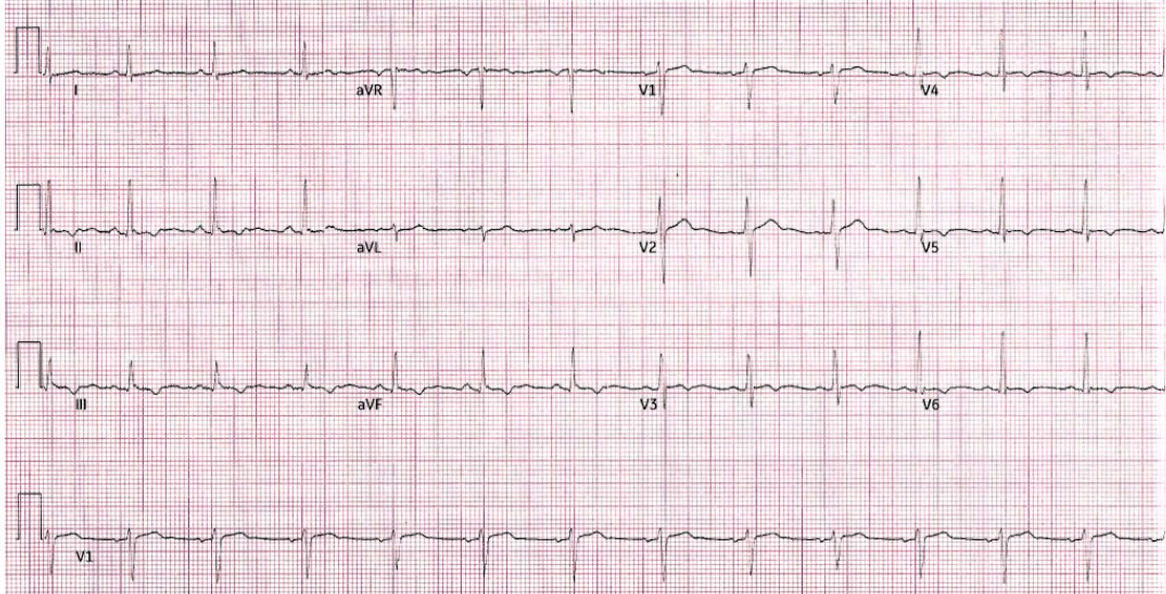 EKG of patient