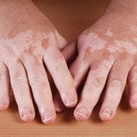 Early Systemic Glucocorticoid Treatment Suggested for Vitiligo Patients