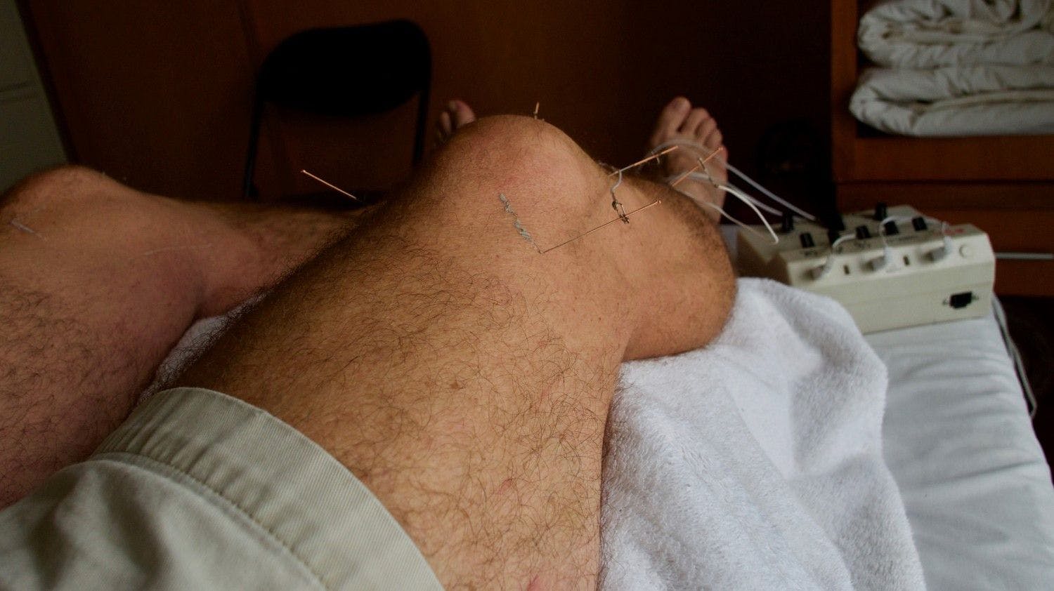 Acupuncture on arthritic knees (©Steve, AdobeStock)