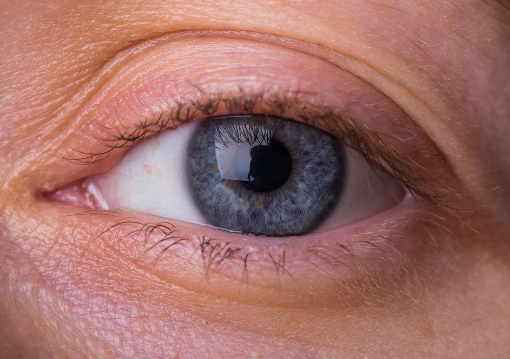 First Treatment for Thyroid Eye Disease Approved by FDA