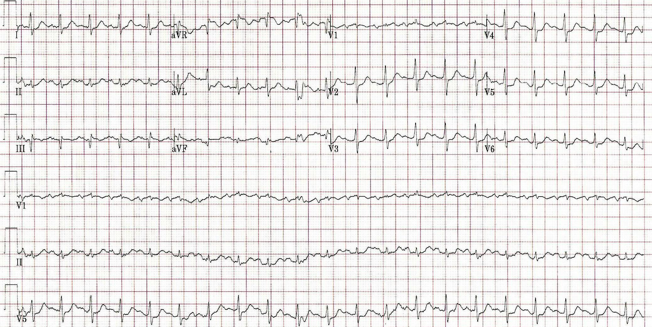 EKG of an ischemic patient experiencing alcohol withdrawal.